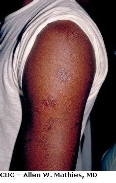 He had no history of herpes simplex virus (HSV) infection . . Herpes rash on arm